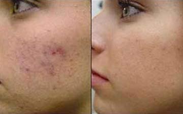 Laser Acne Scar Removal