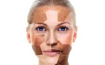 Laser Pigmentation Removal